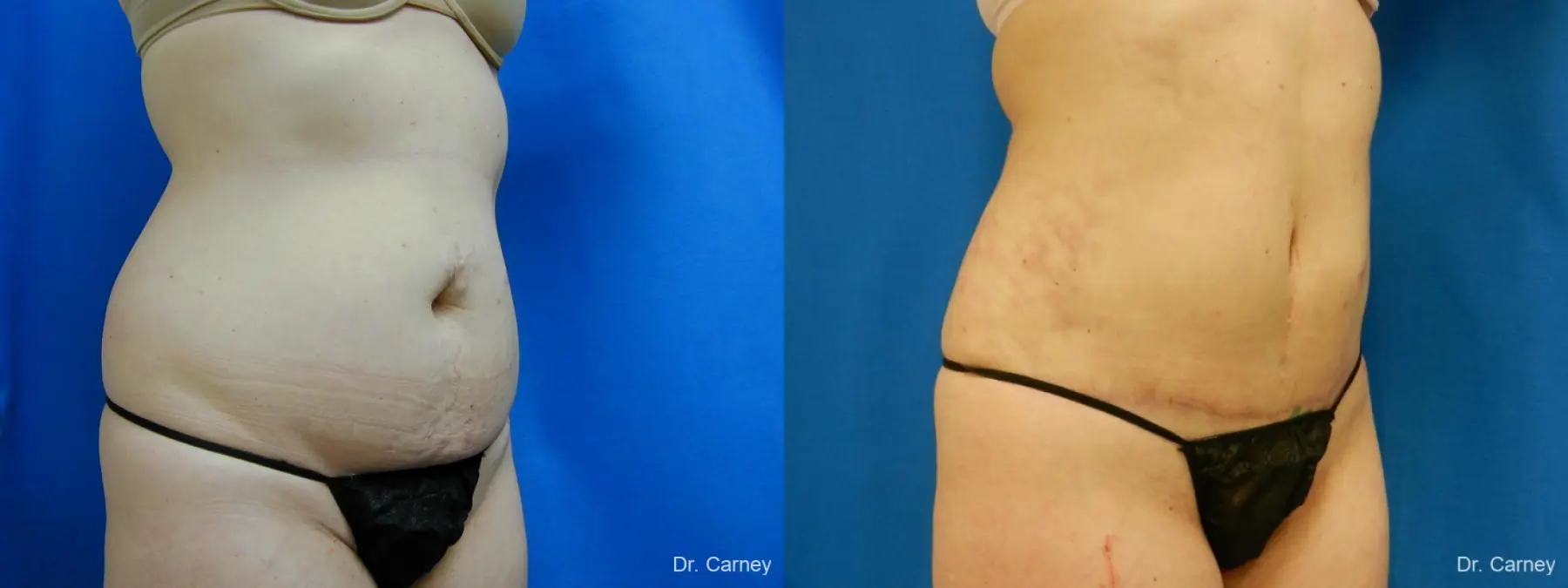 Virginia Beach Tummy Tuck 1251 - Before and After 2