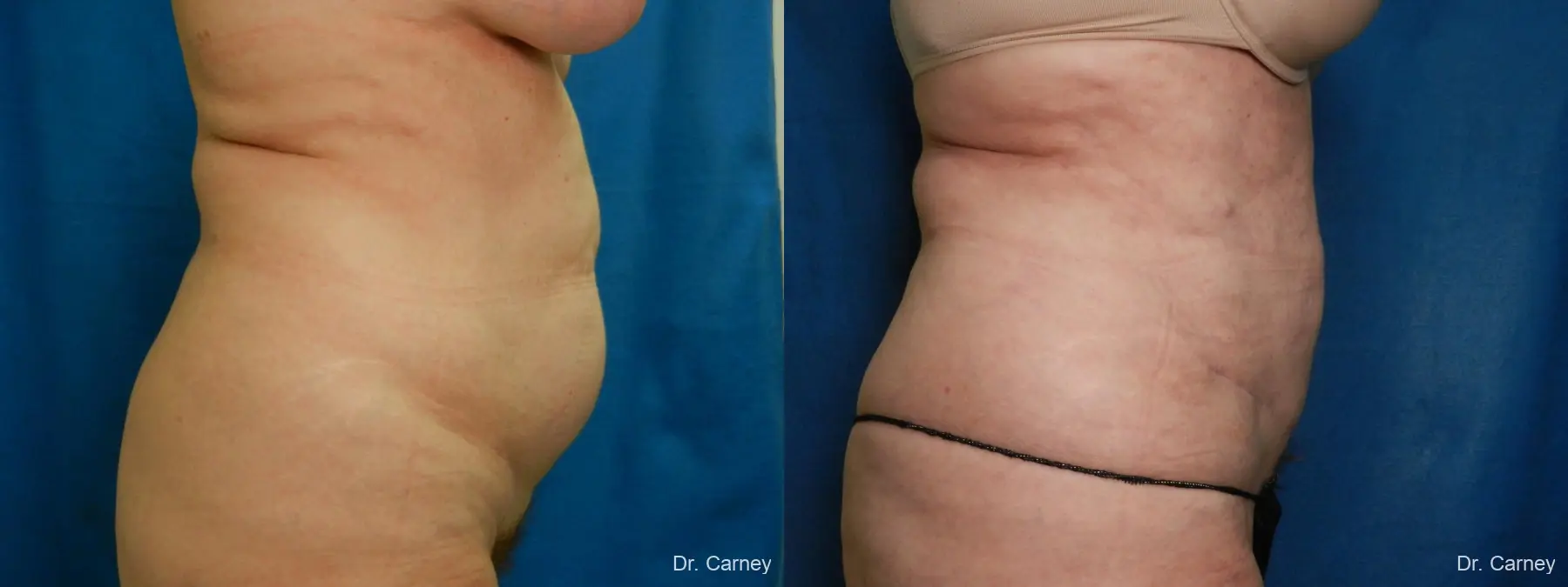 Abdominoplasty: Patient 15 - Before and After 3