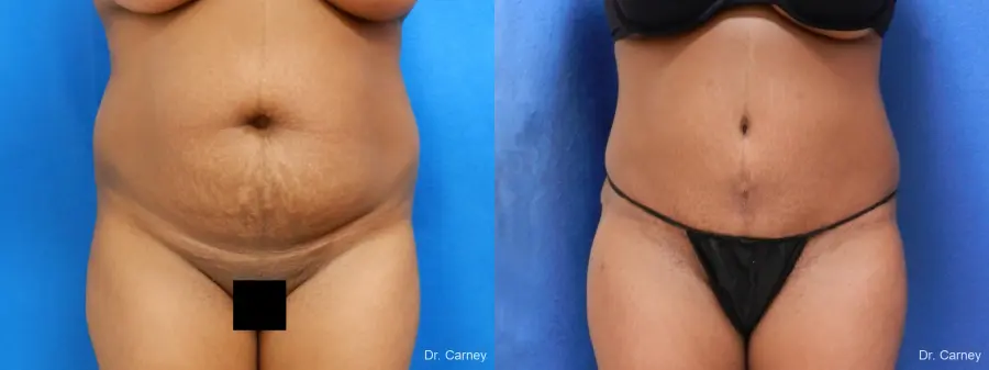 Abdominoplasty: Patient 1 - Before and After 3