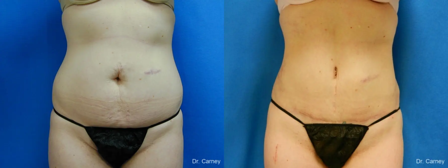 Virginia Beach Tummy Tuck 1251 - Before and After 1