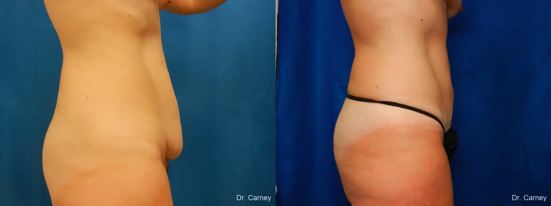 Abdominoplasty: Patient 2 - Before and After 3
