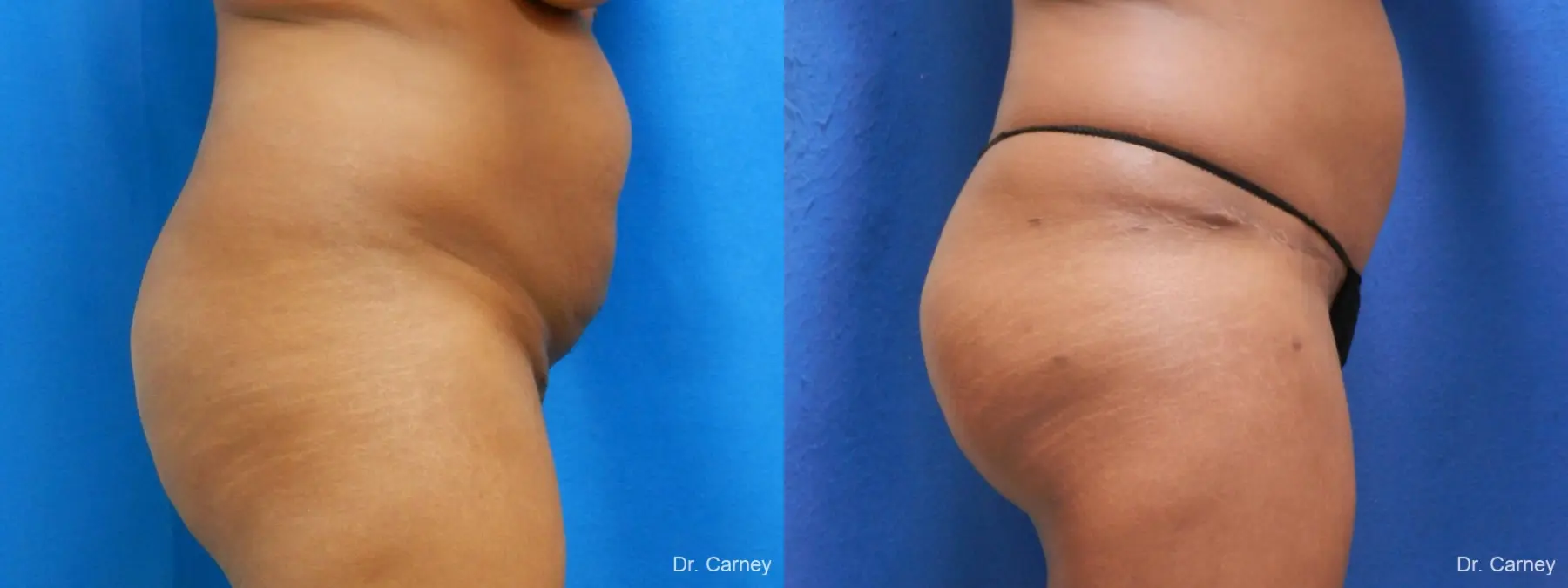 Abdominoplasty: Patient 5 - Before and After 1