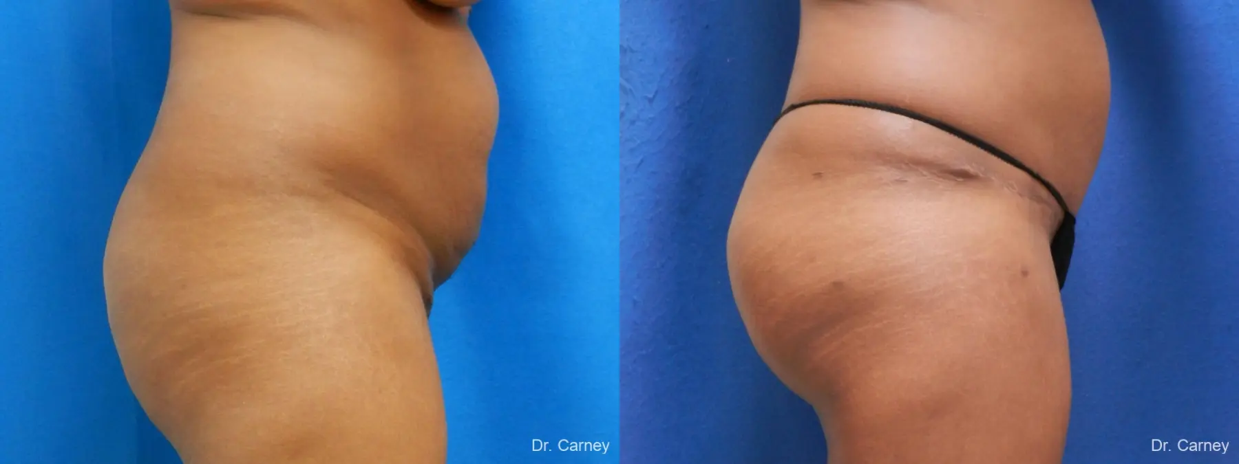 Abdominoplasty: Patient 5 - Before and After  