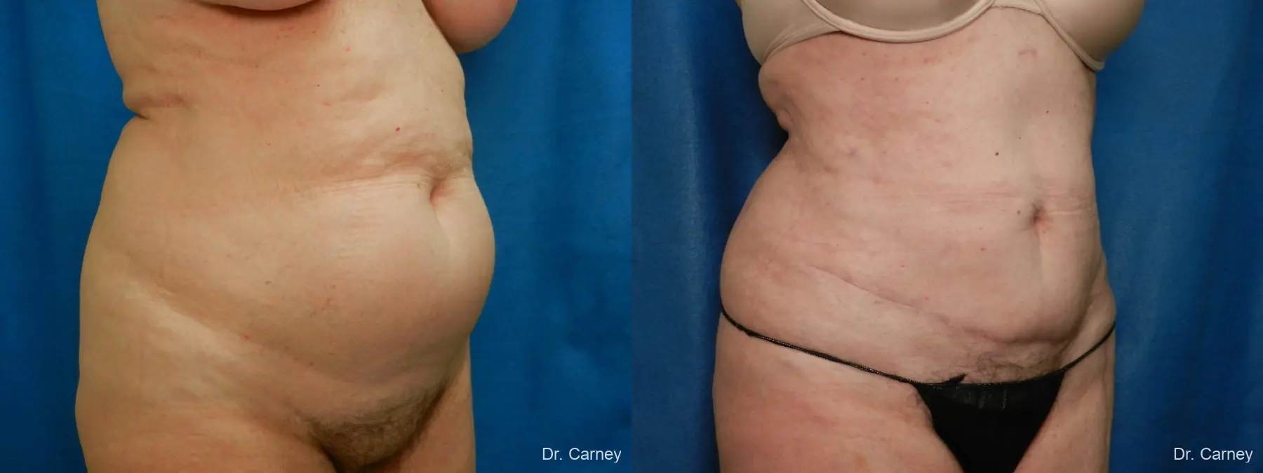 Abdominoplasty: Patient 14 - Before and After 2