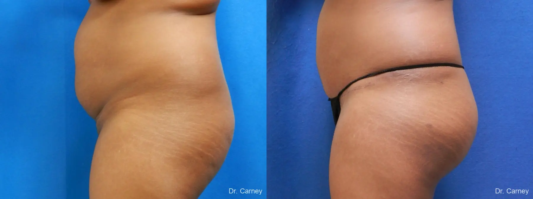 Abdominoplasty: Patient 5 - Before and After 5