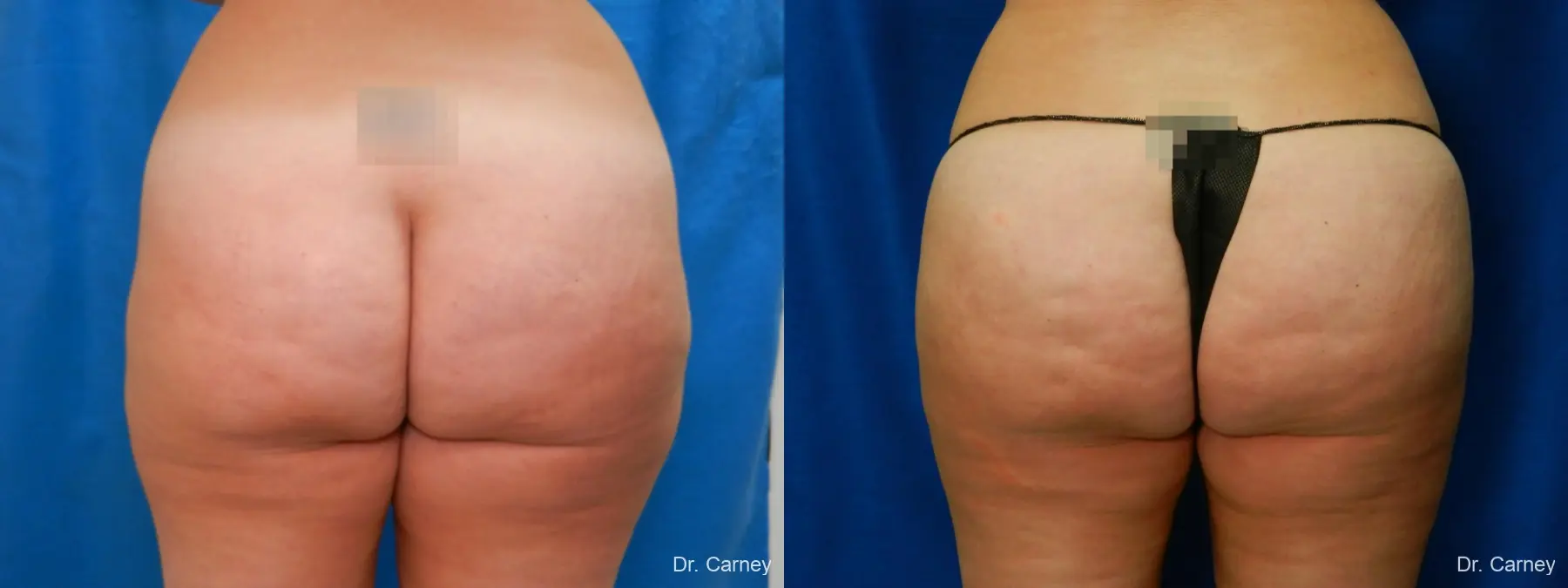 Abdominoplasty: Patient 17 - Before and After 4