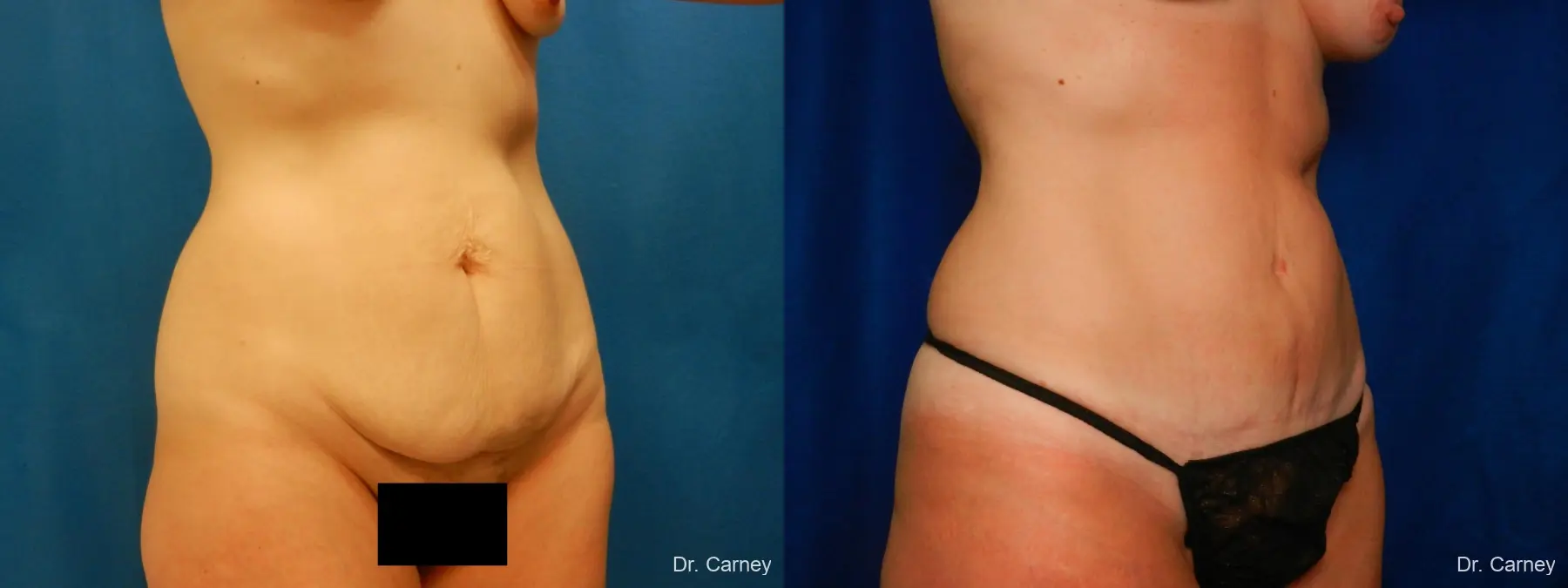Abdominoplasty: Patient 2 - Before and After 2