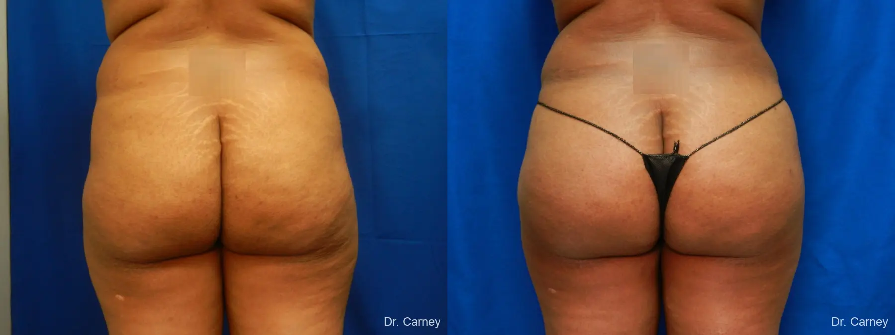 Abdominoplasty: Patient 16 - Before and After 4