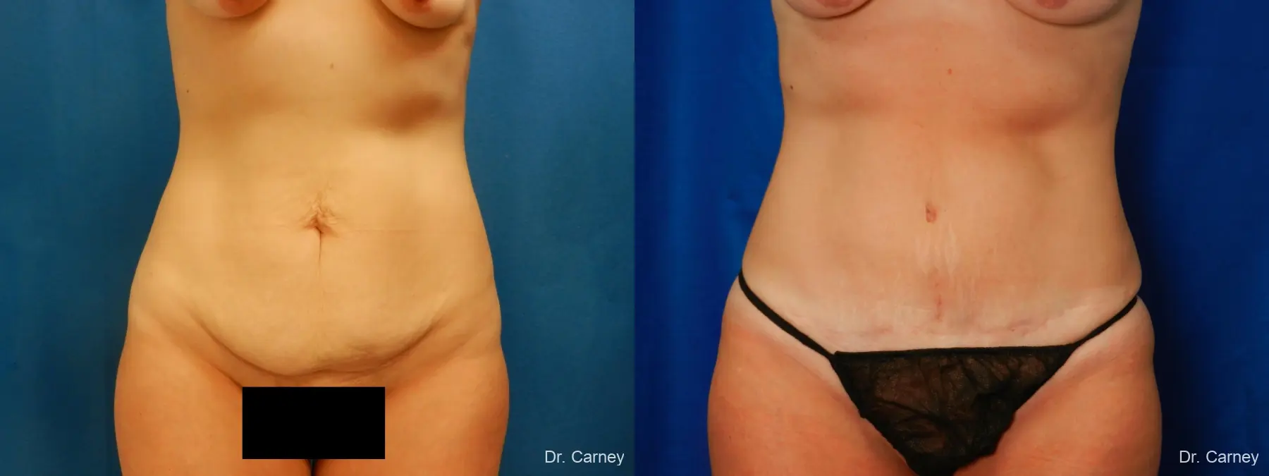 Abdominoplasty: Patient 2 - Before and After 1
