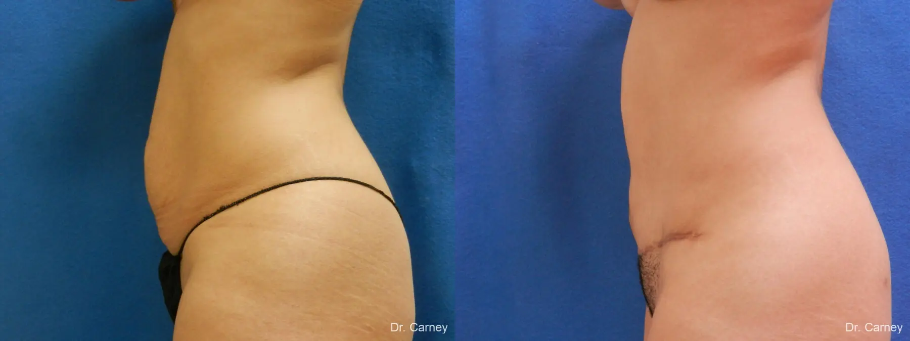 Abdominoplasty: Patient 7 - Before and After 5