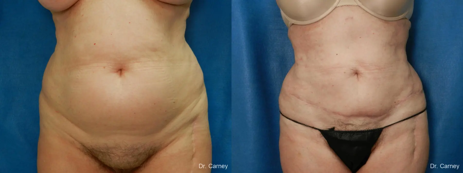 Abdominoplasty: Patient 14 - Before and After 1