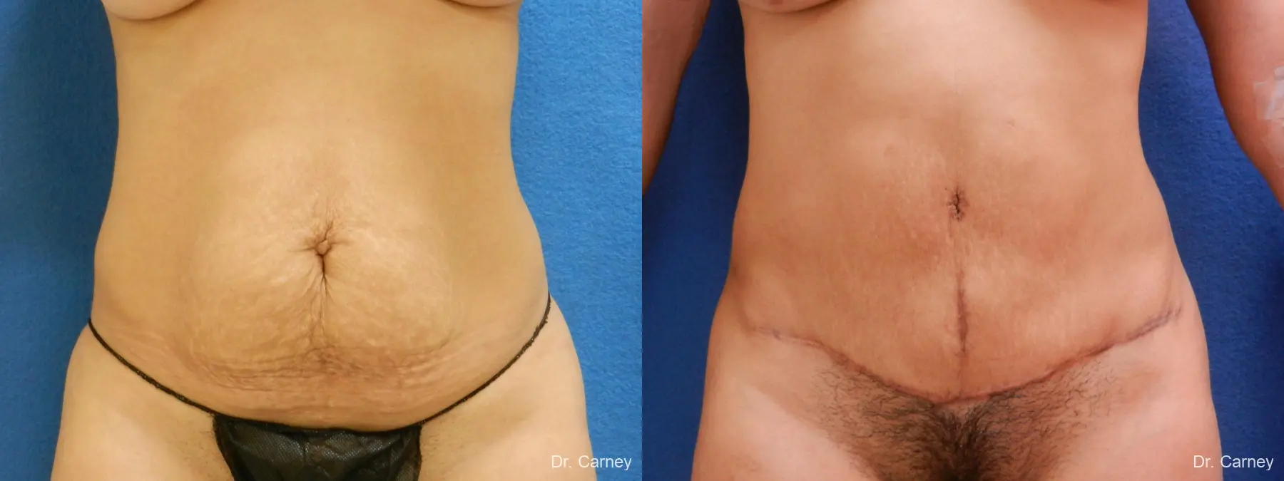 Abdominoplasty: Patient 7 - Before and After 3