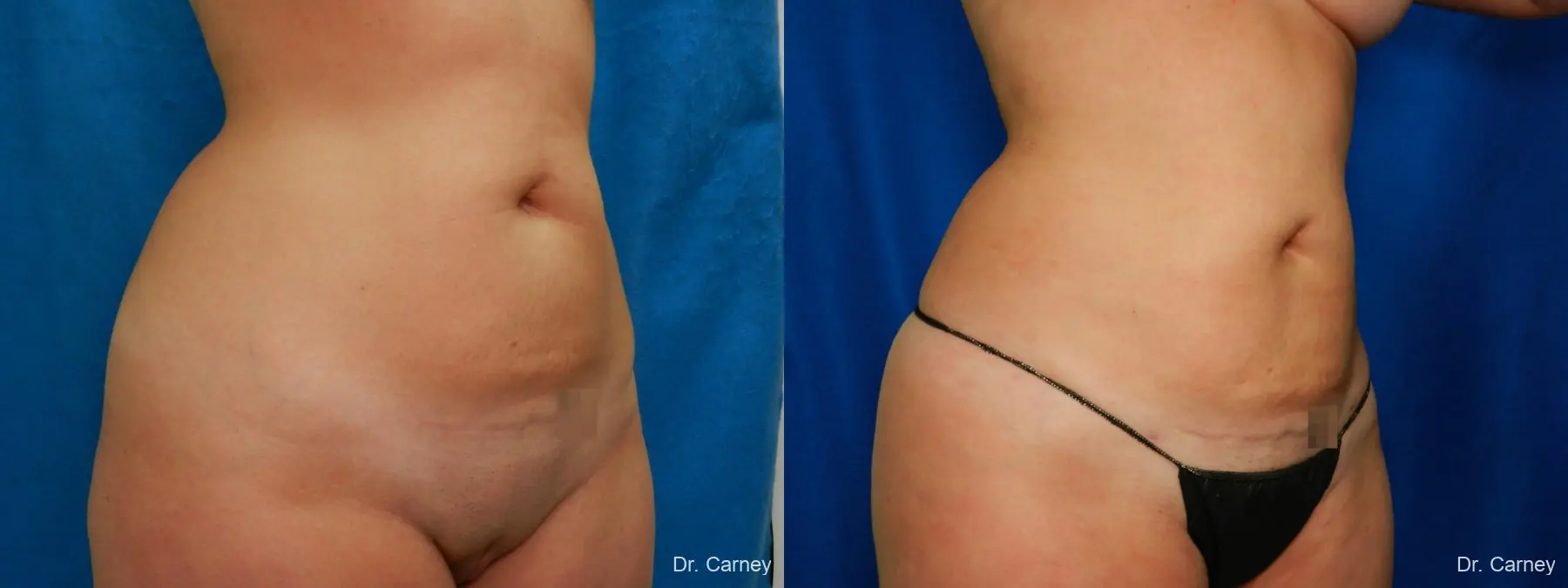 Abdominoplasty: Patient 17 - Before and After 2