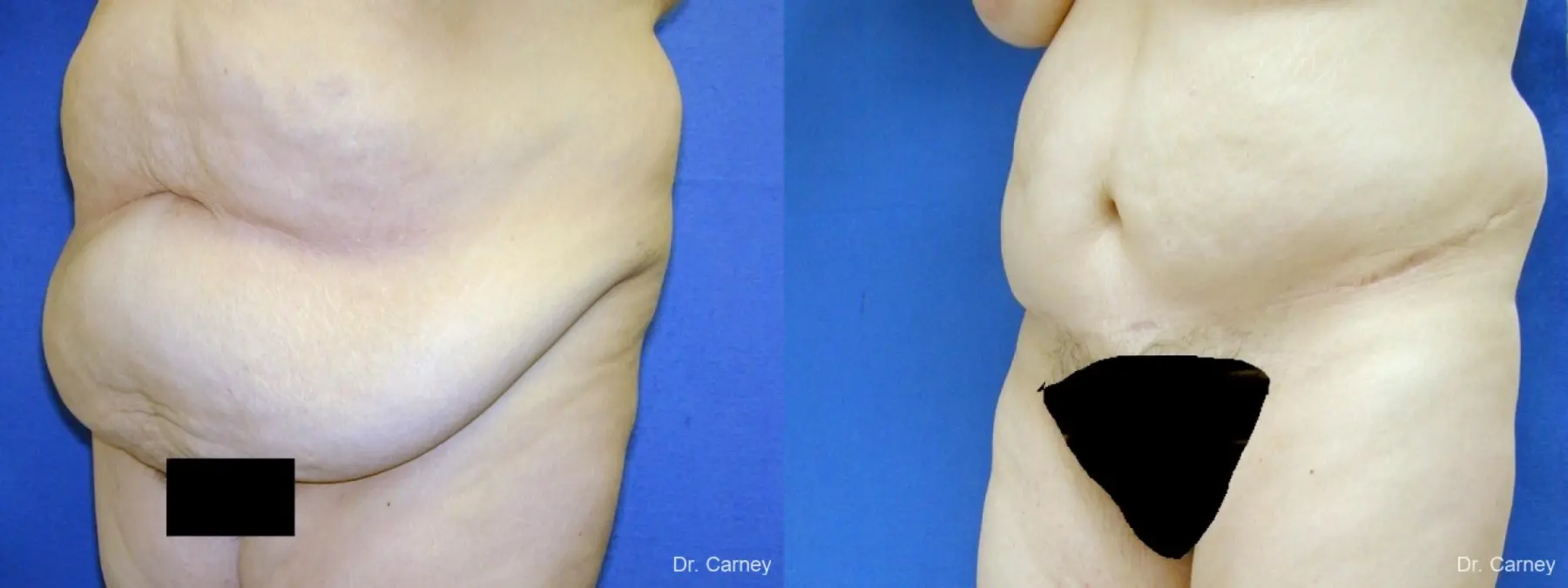 Virginia Beach Tummy Tuck 1250 - Before and After