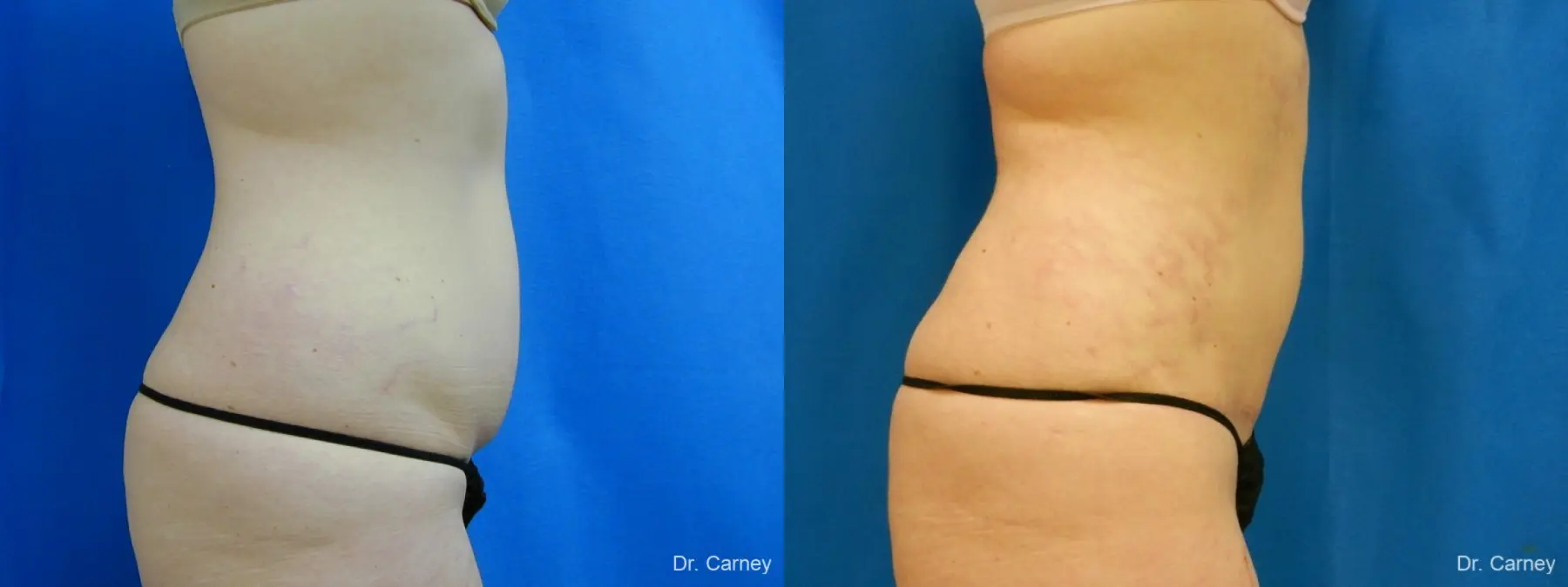 Virginia Beach Tummy Tuck 1251 - Before and After 3
