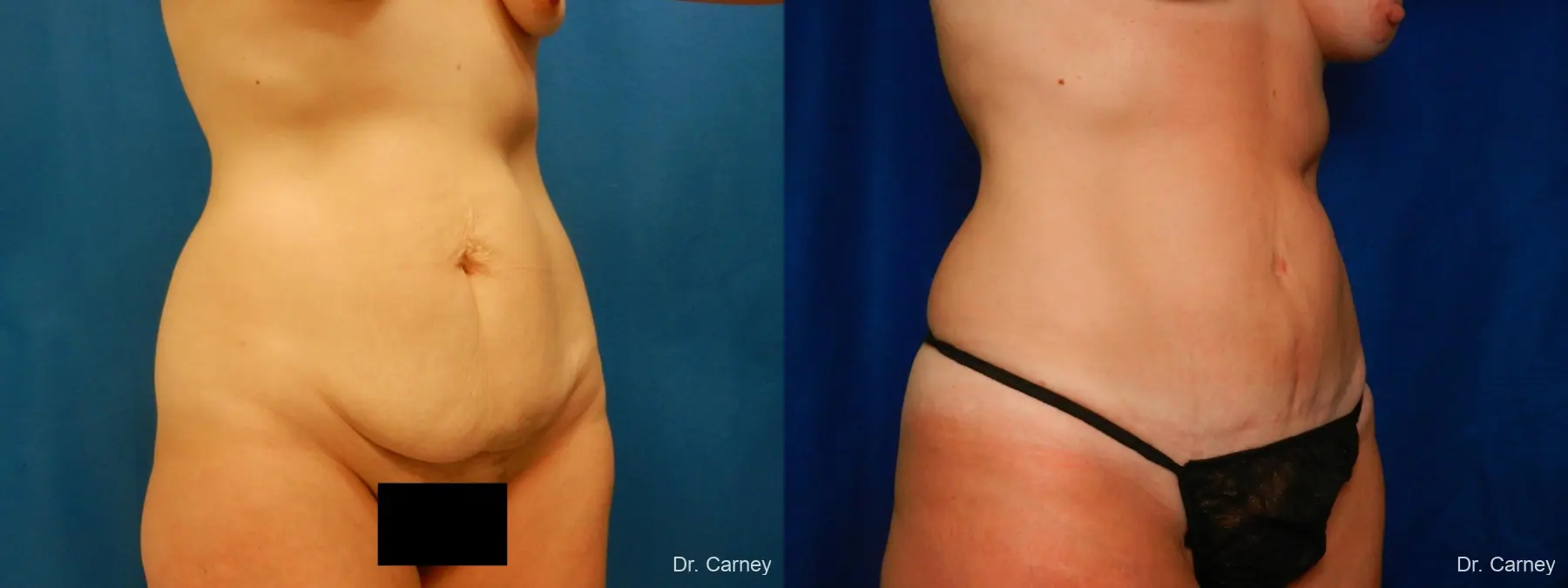 Abdominoplasty: Patient 1 - Before and After 2