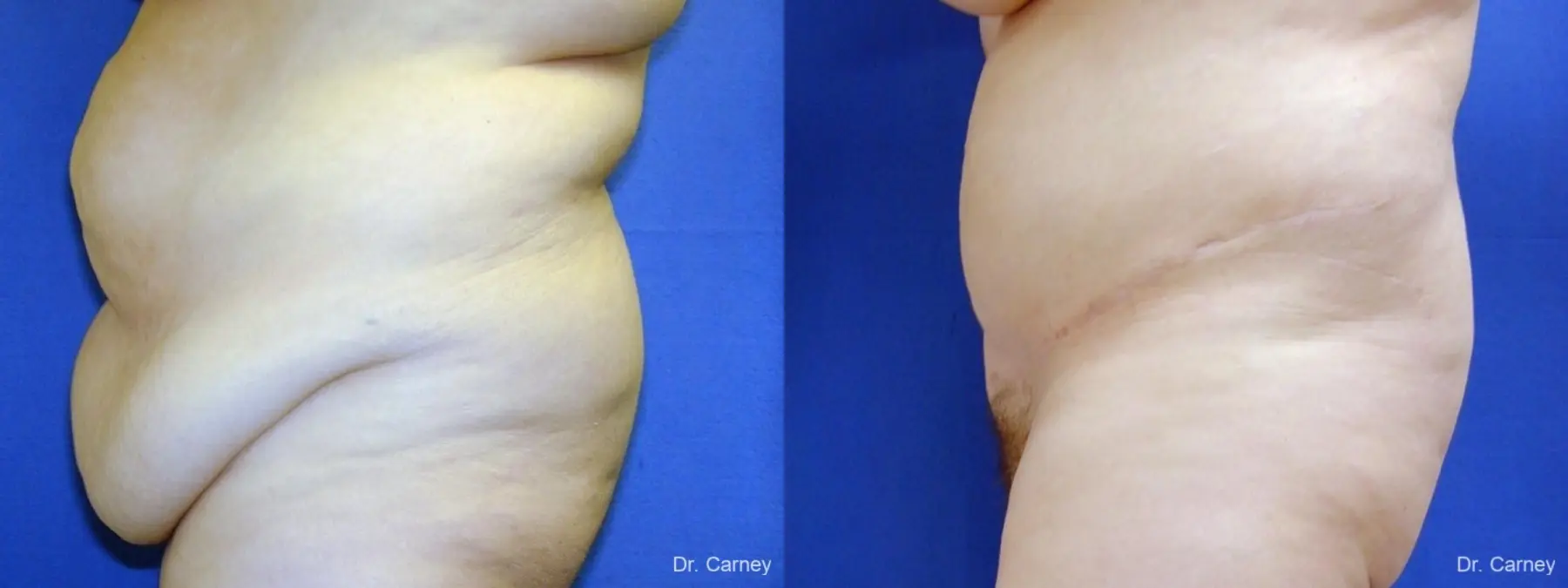 Virginia Beach Tummy Tuck 1250 - Before and After 2