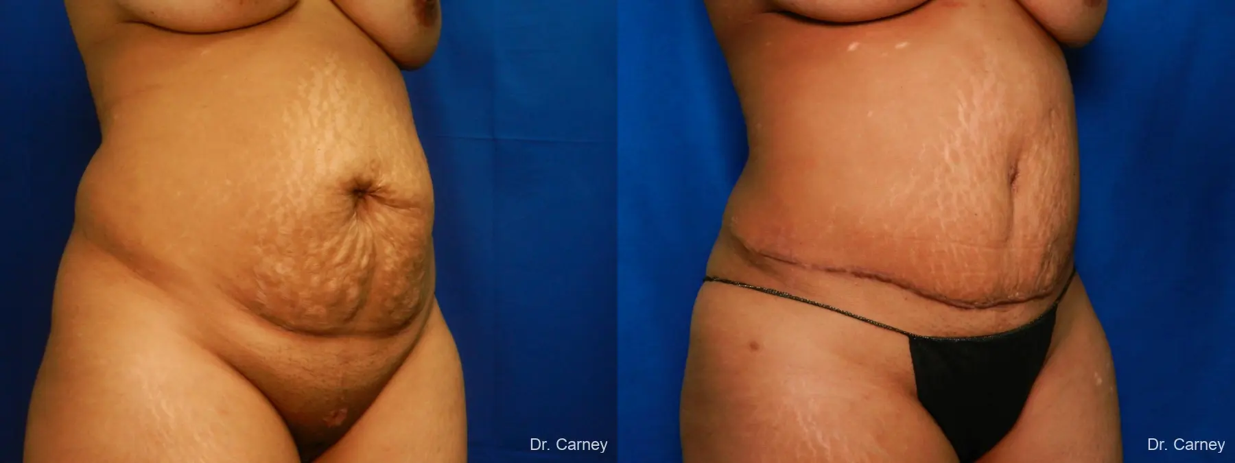 Abdominoplasty: Patient 16 - Before and After 2