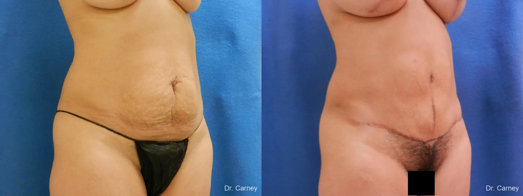 Abdominoplasty: Patient 7 - Before and After 2