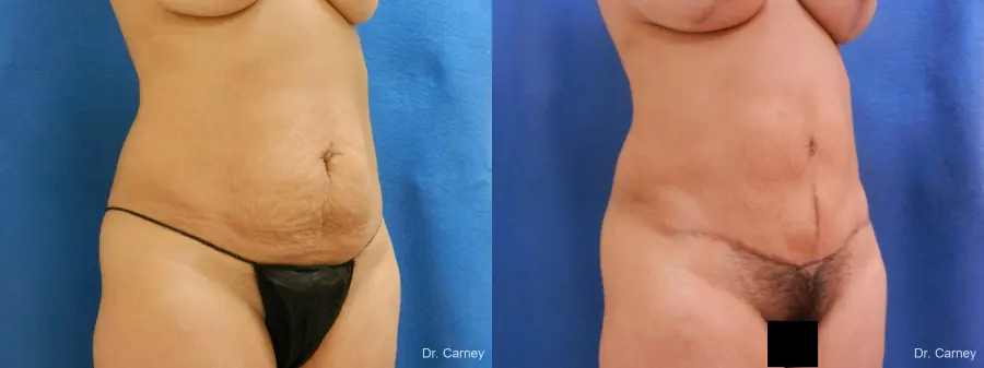 Abdominoplasty: Patient 2 - Before and After 2