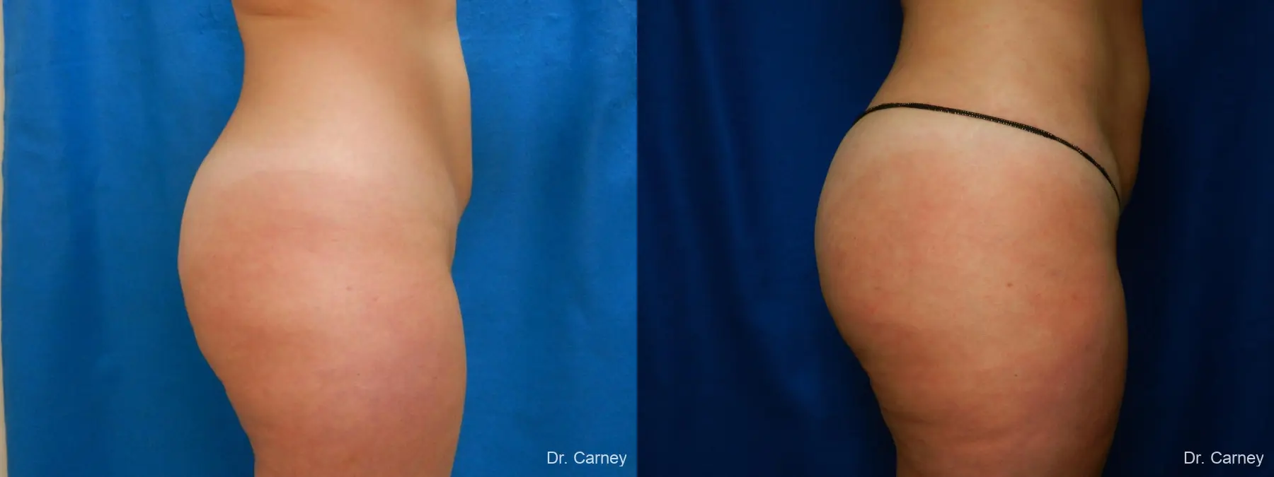 Abdominoplasty: Patient 17 - Before and After 3
