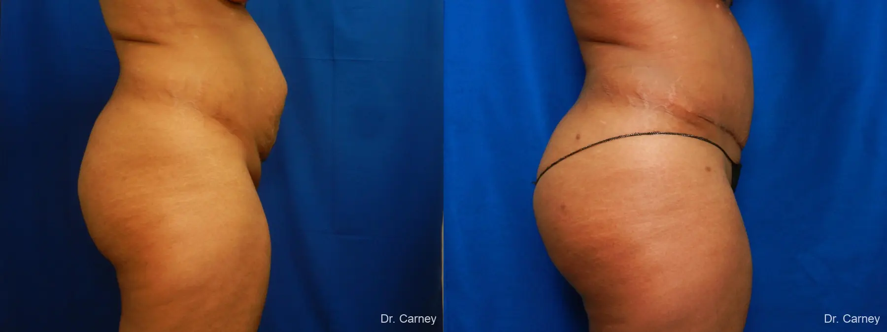 Abdominoplasty: Patient 16 - Before and After 3