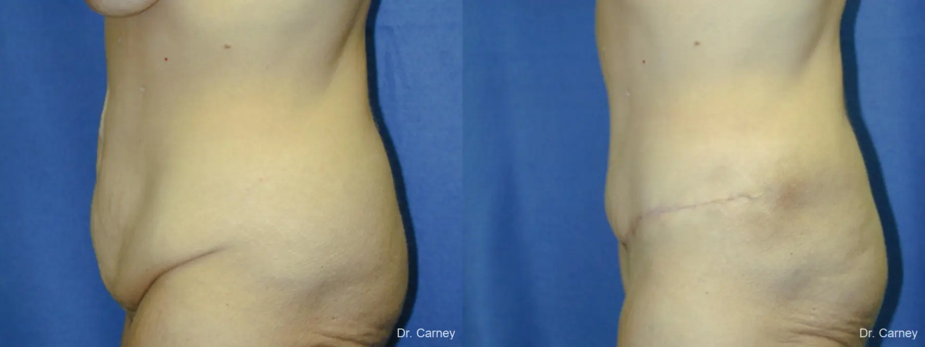 Virginia Beach Tummy Tuck 1249 - Before and After 3