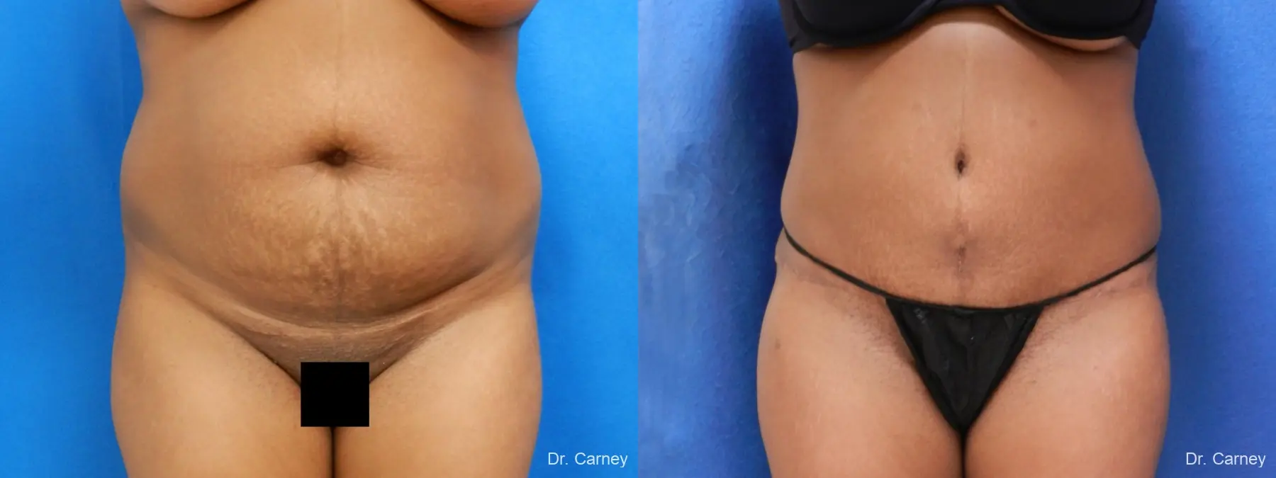 Abdominoplasty: Patient 5 - Before and After 3