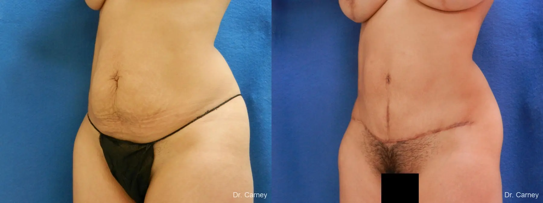 Abdominoplasty: Patient 7 - Before and After 4
