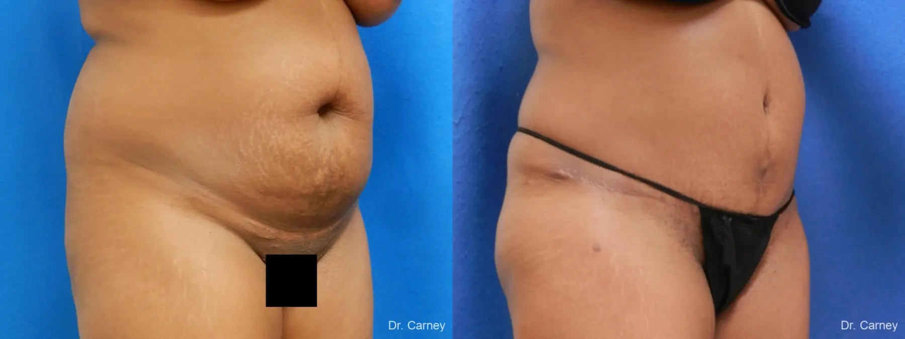 Abdominoplasty: Patient 5 - Before and After 2