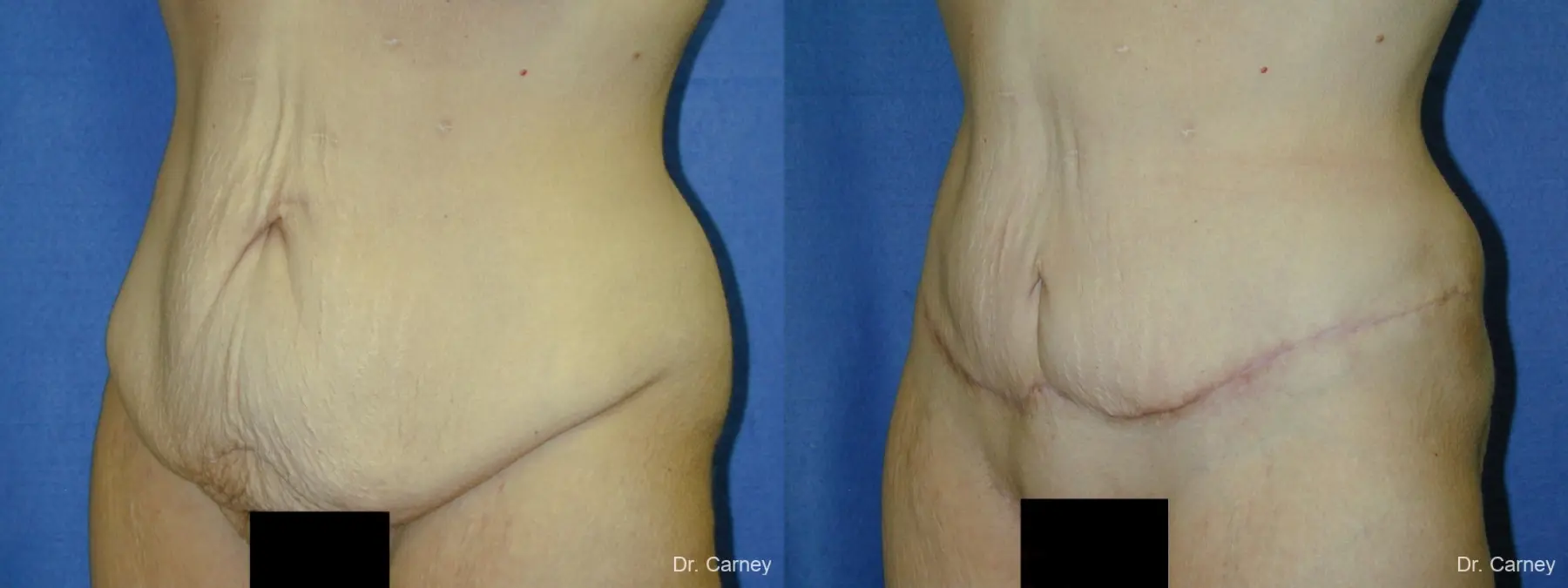 Virginia Beach Tummy Tuck 1249 - Before and After 1