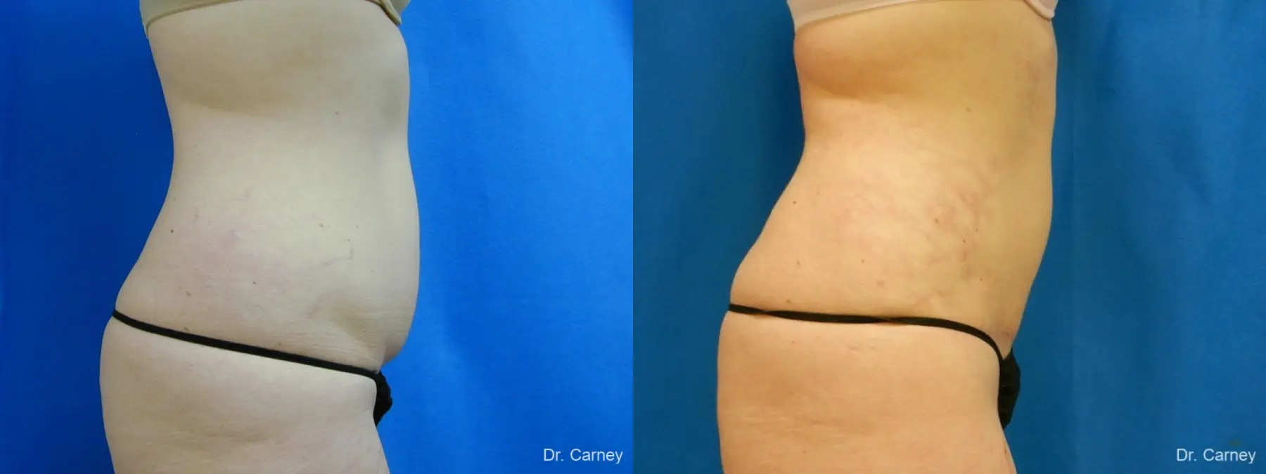 Virginia Beach Tummy Tuck 1251 - Before and After 3