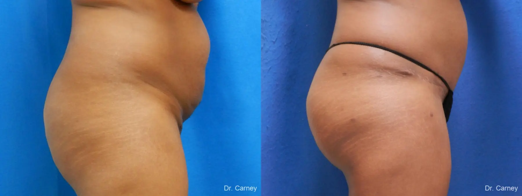 Abdominoplasty: Patient 6 - Before and After 1