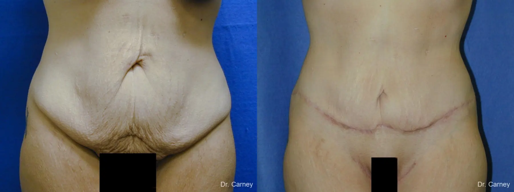Virginia Beach Tummy Tuck 1249 - Before and After 2