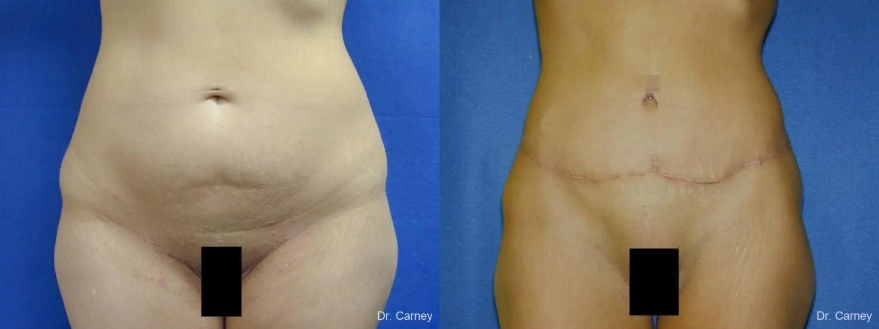 Abdominoplasty: Patient 18 - Before and After  