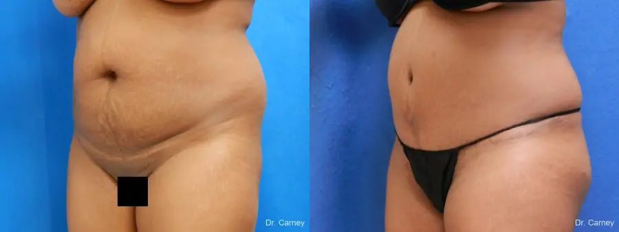 Abdominoplasty: Patient 1 - Before and After 4