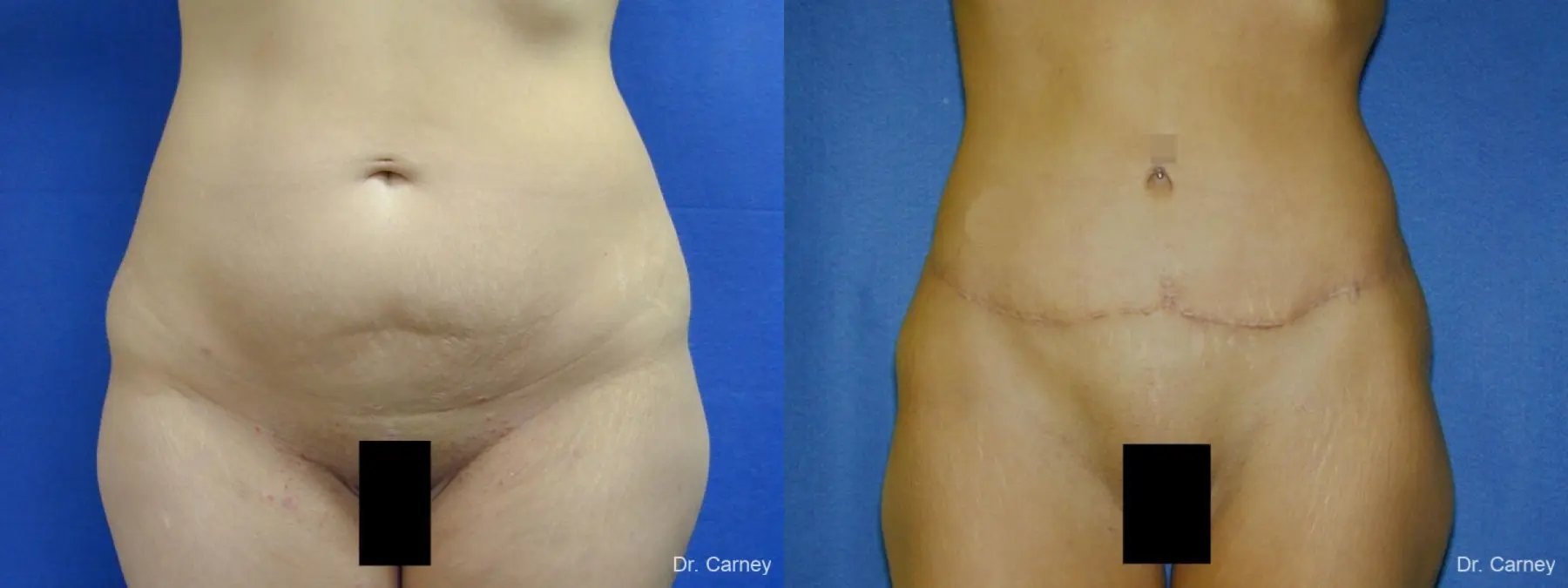Abdominoplasty: Patient 9 - Before and After  