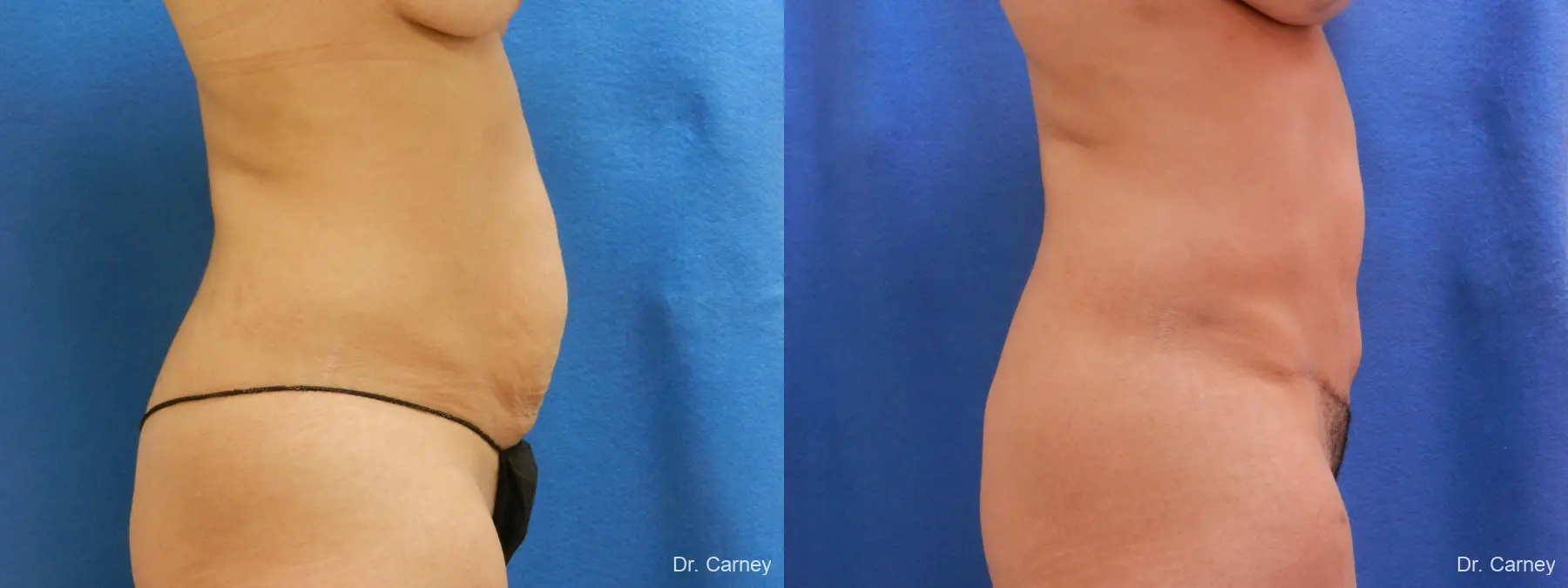 Abdominoplasty: Patient 7 - Before and After 1