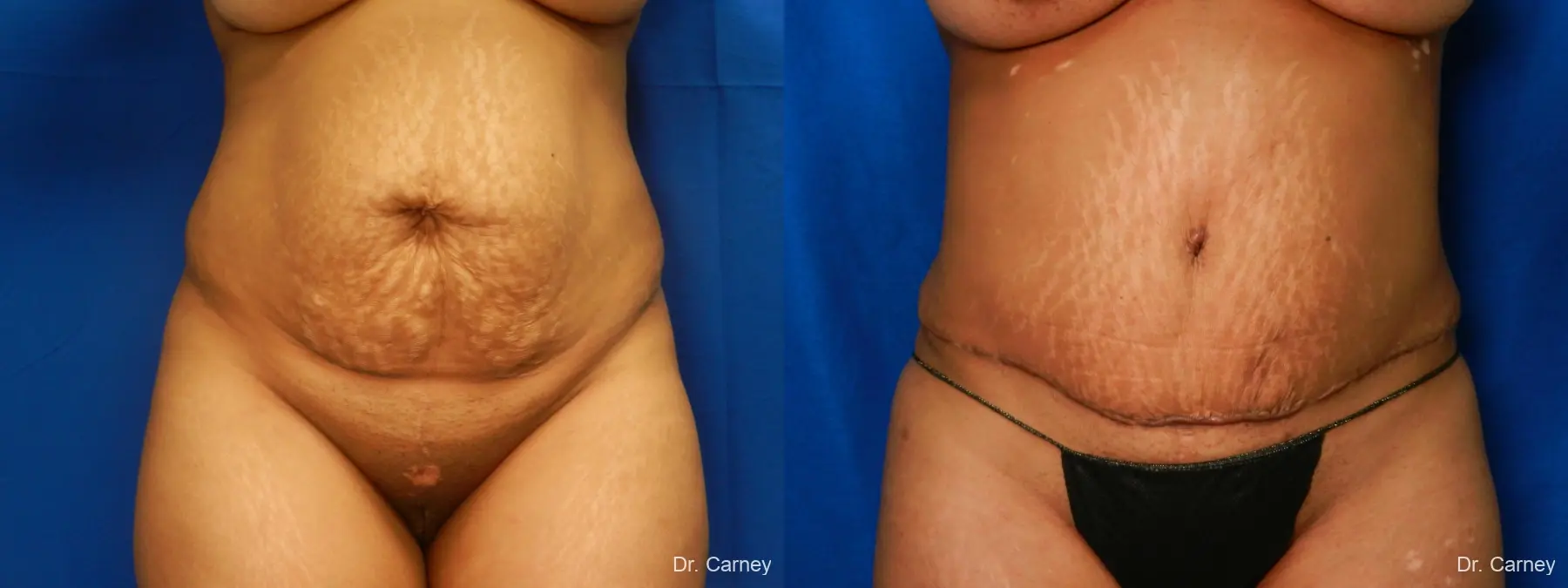 Abdominoplasty: Patient 16 - Before and After 1