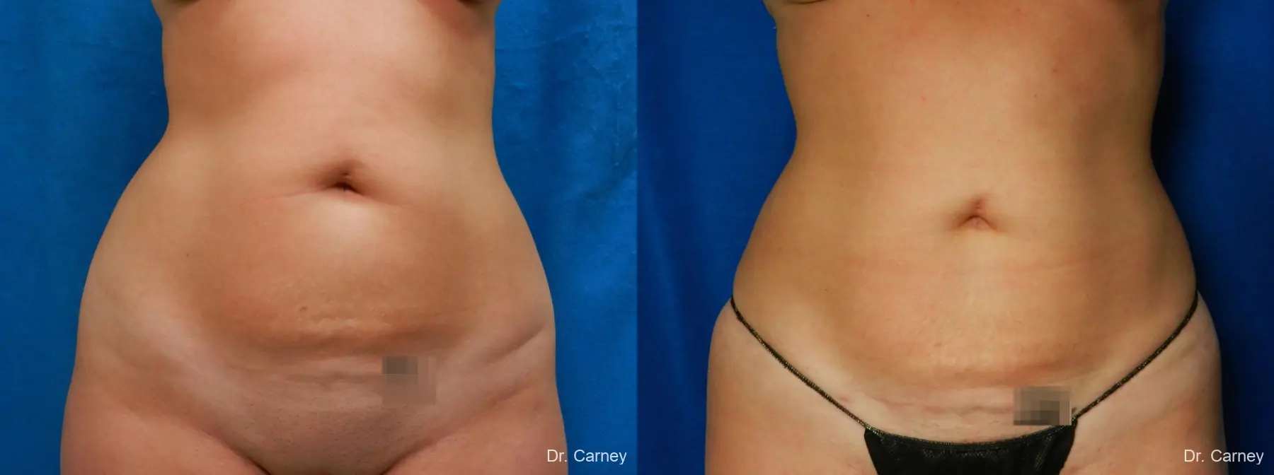 Abdominoplasty: Patient 17 - Before and After 1