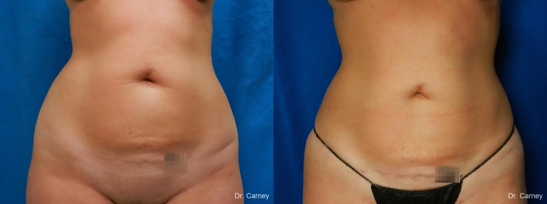 Abdominoplasty: Patient 17 - Before and After  