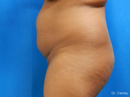 Abdominoplasty: Patient 1 - Before and After Image 5