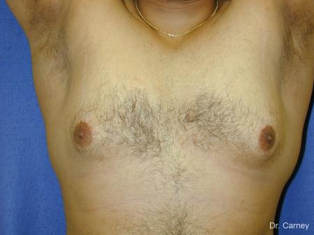 Virginia Beach Gynecomastia 1255 - Before Image 2