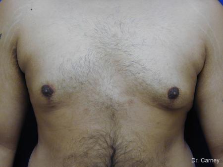Virginia Beach Gynecomastia 1255 - After Image 4