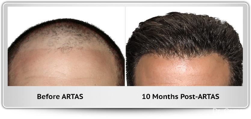 Hair Transplantation: Patient 9 - Before and After 1
