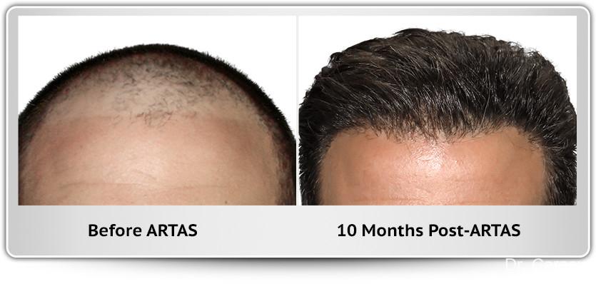 Hair Transplantation: Patient 9 - Before and After  