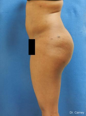 Brazilian Butt Lift: Patient 6 - After Image 1