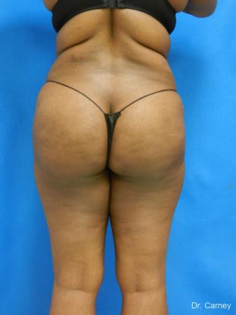 Brazilian Butt Lift: Patient 4 - After Image 3