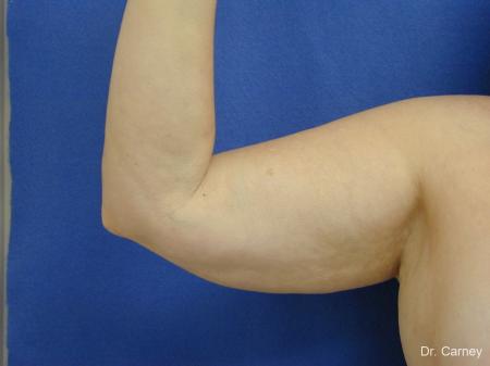 Virginia Beach Brachioplasty 1144 - Before and After Image 3