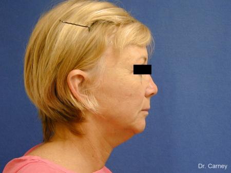 Virginia Beach Facelift 1262 - Before Image 4